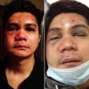 Vhong Navarro Seriously Injured After Being Beaten Up…